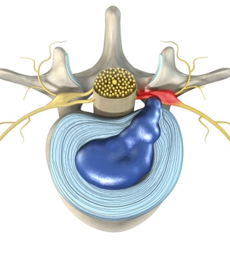 Κήλη μεσοσπονδύλιου δίσκου